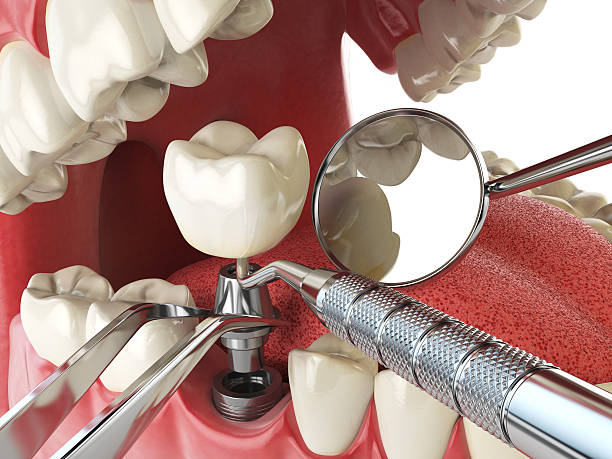 Emergency Dental Filling Replacement in DE